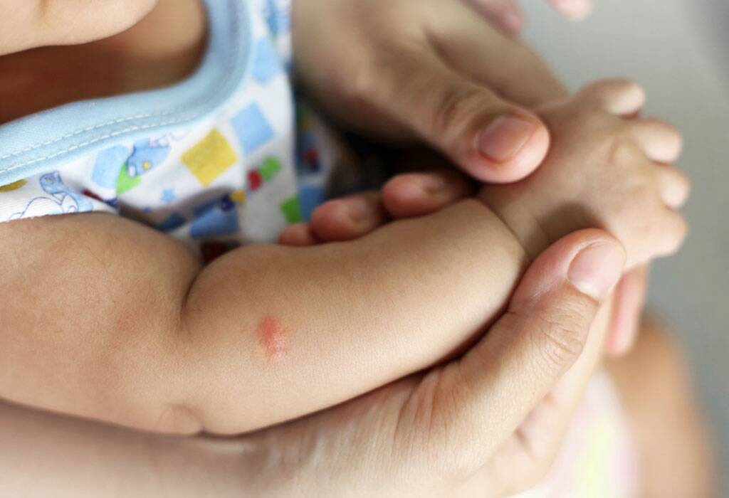 Bayi Digigit Serangga? Segera Lakukan 6 Hal Ini Moms!