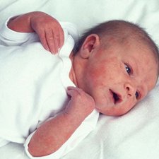 Penyebab Timbulnya Bintik Merah Pada Kulit Bayi