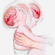 Yuk Moms Kenali Shaken Baby Syndrome