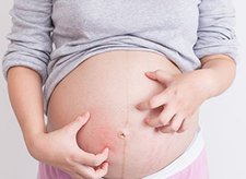 Gatal-gatal Berlebihan Saat Hamil, Mungkin Moms Terkena Kolestasis Obstetri