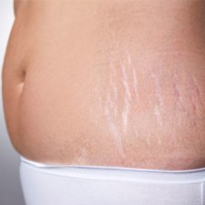5 Bagian tubuh ini akan muncul stretch mark saat hamil