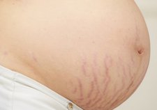 Review : Mooimom Belly Cream Ampuh Hapus Stretch Mark Ibu Hamil