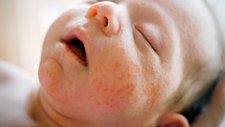 6 Cara Mengatasi Biang Keringat pada si Kecil