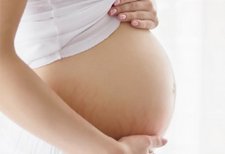 10 Fakta Tentang Stretch Mark Pada Ibu Hamil