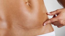 Cara Menghilangkan Keloid Bekas Operasi Caesar